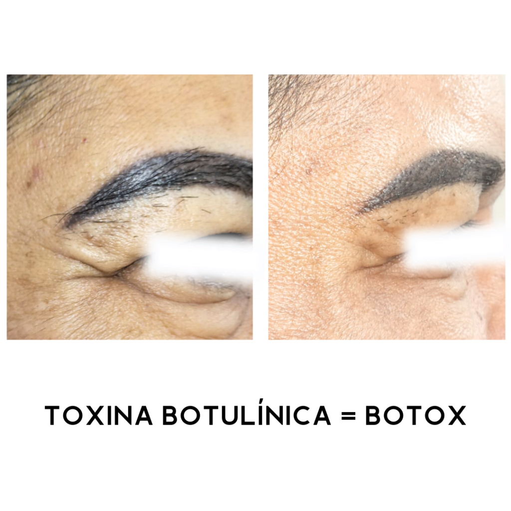 TOXINA-BOTULINICA-BOTOX-10.png