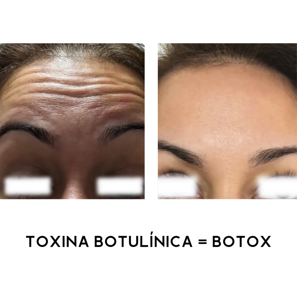 TOXINA-BOTULINICA-BOTOX-4.png