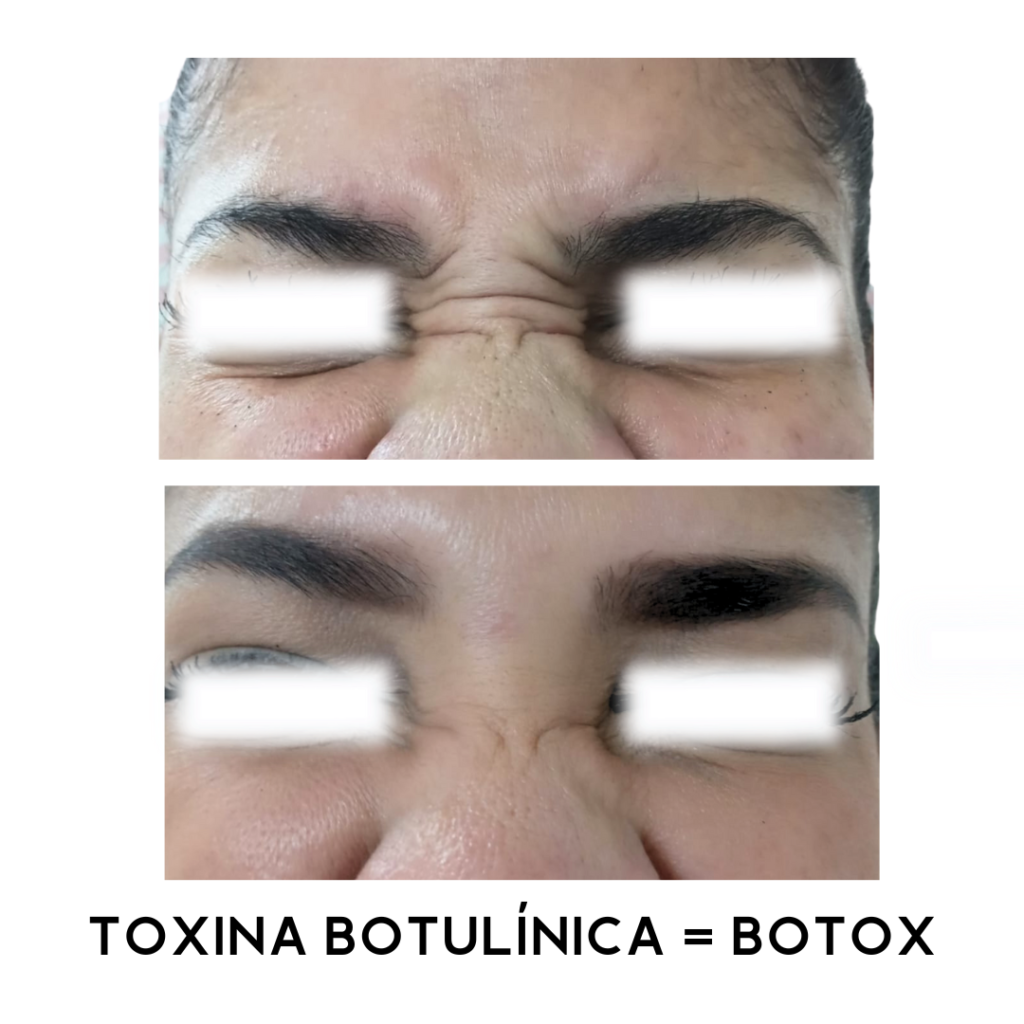 TOXINA-BOTULINICA-BOTOX-5.png