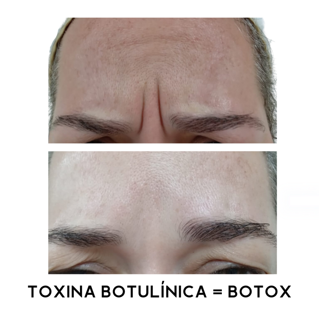 TOXINA-BOTULINICA-BOTOX-6.png