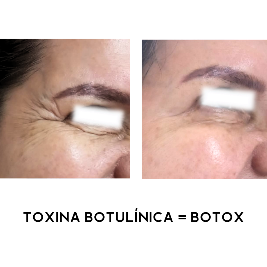 TOXINA-BOTULINICA-BOTOX-7.png