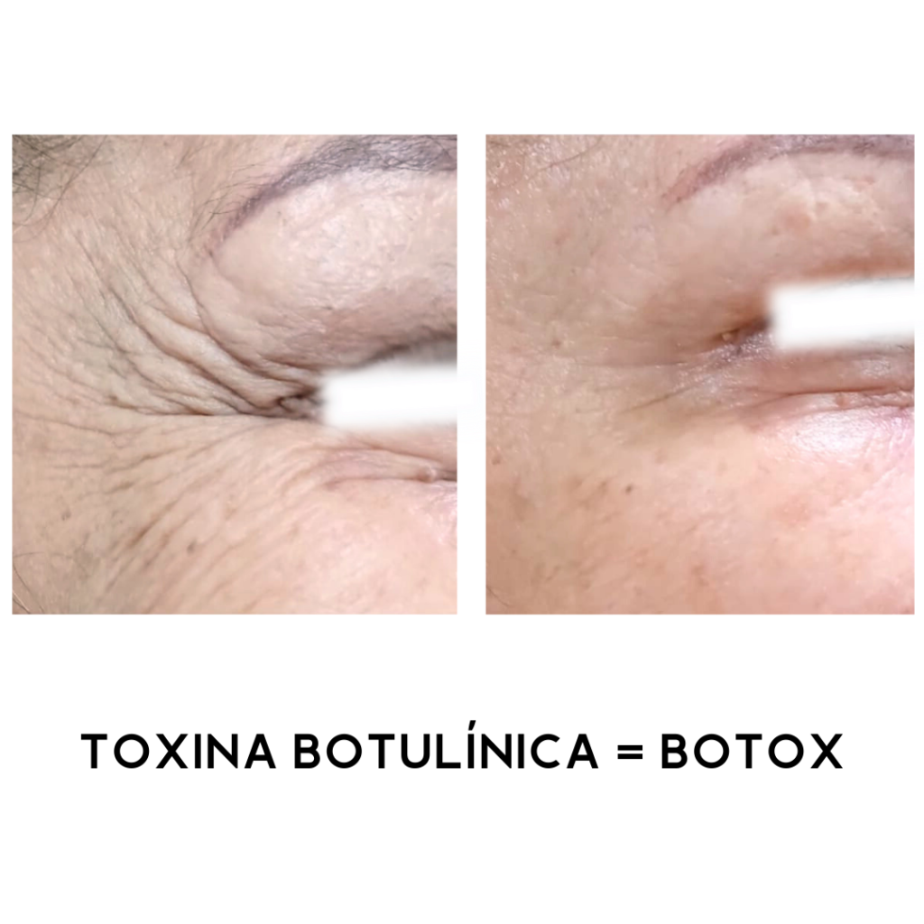 TOXINA-BOTULINICA-BOTOX-8.png