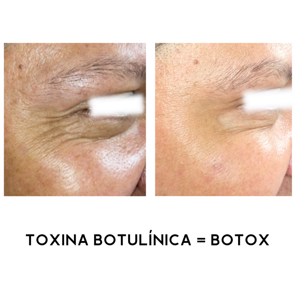 TOXINA-BOTULINICA-BOTOX-9.png