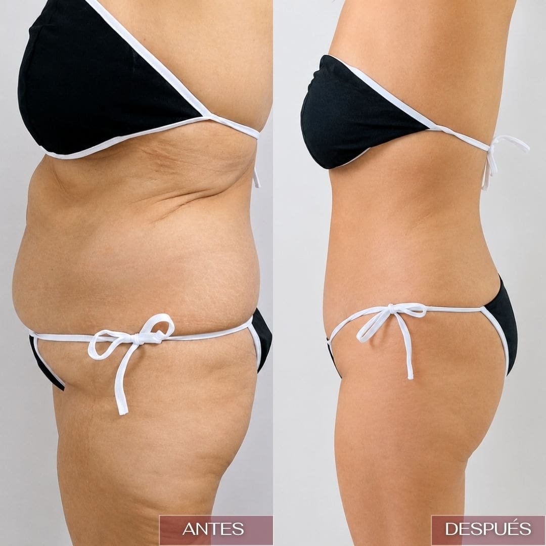 resultados-lipo-en-fio-barranquilla-1.jpg