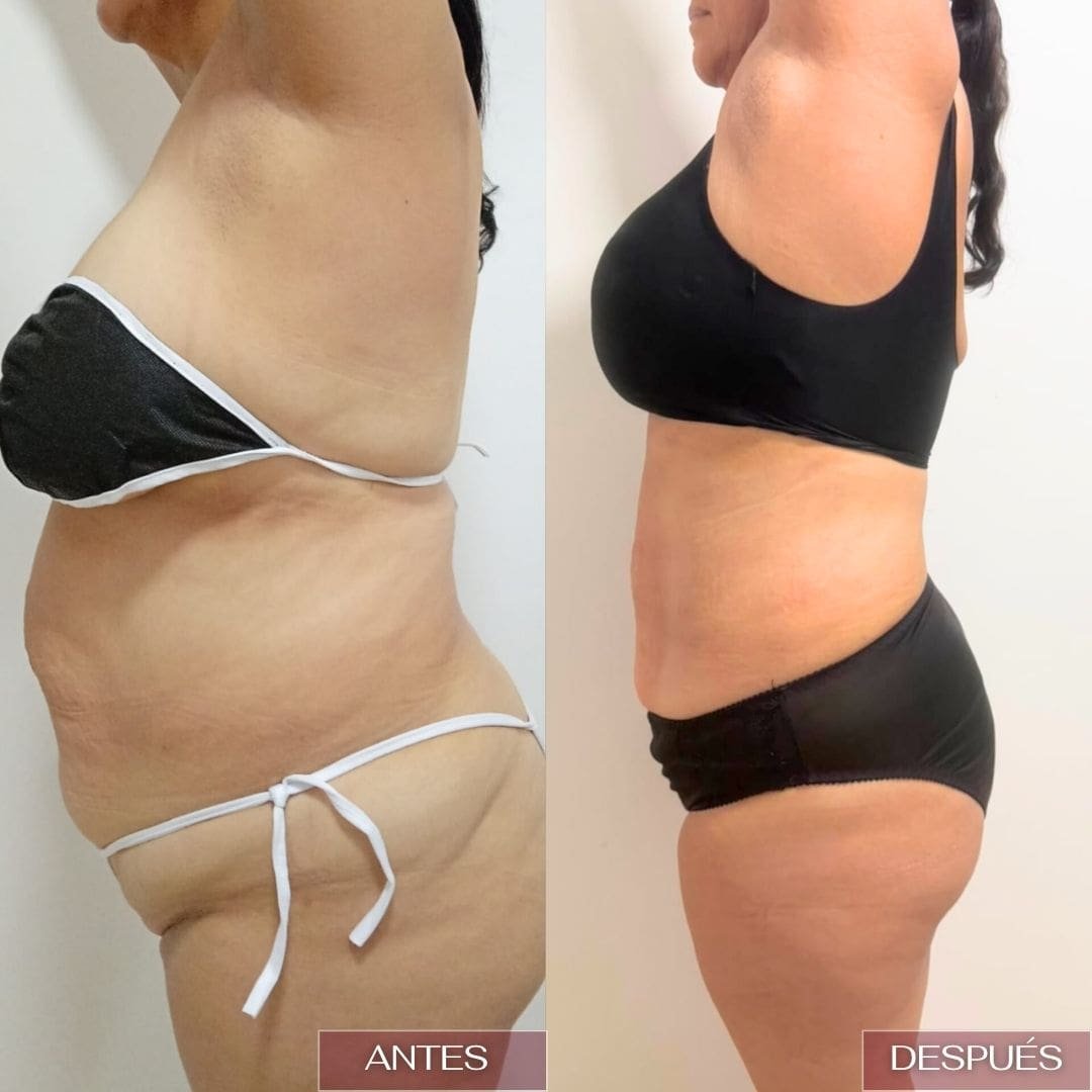 resultados-lipo-en-fio-barranquilla-3.jpg