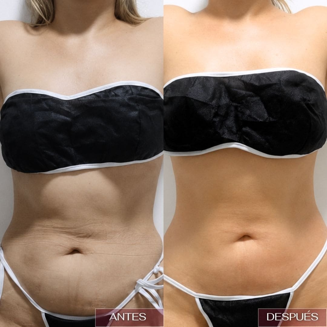 resultados-lipo-en-fio-barranquilla-4.jpg